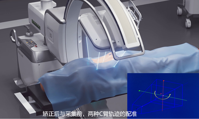 什么是骨科手術導航定位系統(tǒng)配準 一體化自適應配準有什么優(yōu)勢